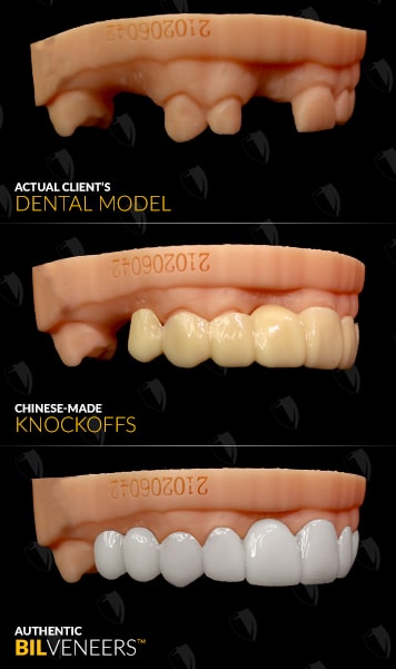 Authentic Bil Veneers - No Thermoform - Not Made In China!
