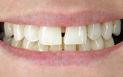 Slider-Heather-Before